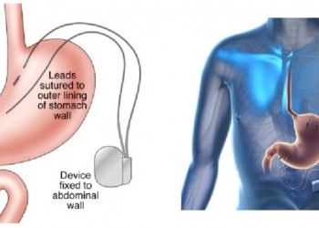 Gastric Electric Stimulators Market Global Competitive Research Report 2019-2025 – Market Research Journals