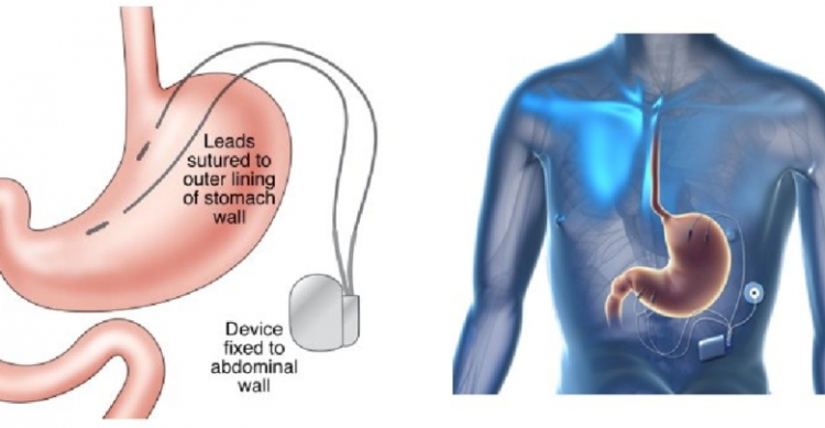 Gastric Electric Stimulators Market Global Competitive Research Report 2019-2025 – Market Research Journals