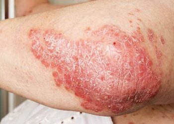 Age at psoriasis onset reveals whether patients with PsA develop psoriasis or arthritis first