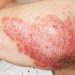 Age at psoriasis onset reveals whether patients with PsA develop psoriasis or arthritis first