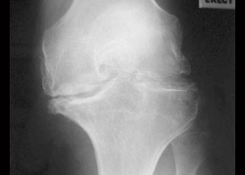 No Subgroup More Likely to Benefit From to Meniscal Surgery