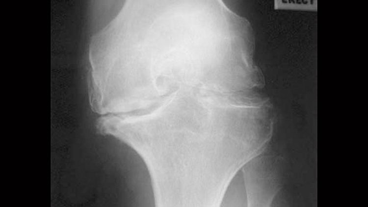 No Subgroup More Likely to Benefit From to Meniscal Surgery
