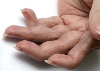 Effect of Aging on 28-Joint Disease Activity Score in Rheumatoid Arthritis