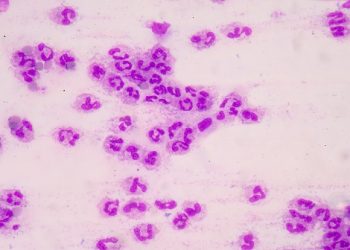 Twice as Many Individuals Die of Sepsis Than Previously Estimated