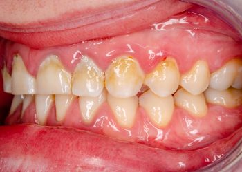 Examining the Associations Between Oral Nitrate-Reducing Bacteria and Cardiometabolic Outcomes
