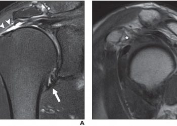 MRI Findings Predict Shoulder Stiffness for Rotator Cuff Tears – Global Health News Wire