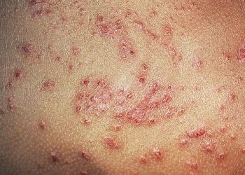 A New Instrument Measures the Experience of Eczema Control in Adults and Children