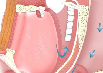 Atomoxetine Plus Oxybutynin Improves Multiple Variables in Obstructive Sleep Apnea
