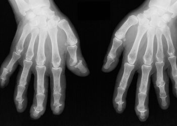 Higher Burden of Bone Damage at the Metacarpal Heads Among Patients With PsA