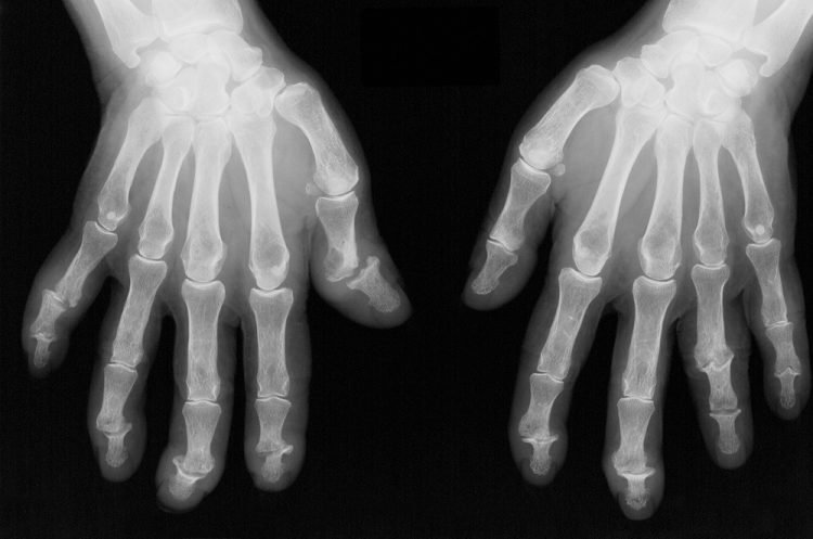 Higher Burden of Bone Damage at the Metacarpal Heads Among Patients With PsA