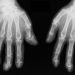 Higher Burden of Bone Damage at the Metacarpal Heads Among Patients With PsA
