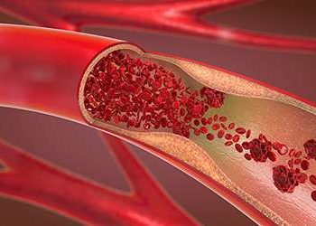 Drug affecting high cholesterol from genes, not lifestyle, shines in KU trial