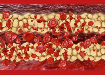 Interleukin 6 May Predict CAC Progression, Death in Dialysis