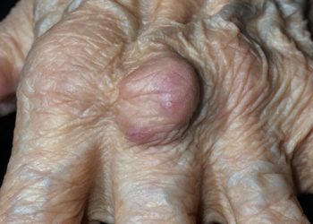 Serum CA72-4 Elevated in Gout, Predicts Future Flares in Patients With Gouty Arthritis