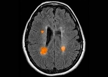Patients With Newly Diagnosed Multiple Sclerosis More Likely to Have Impaired Cognitive Performance