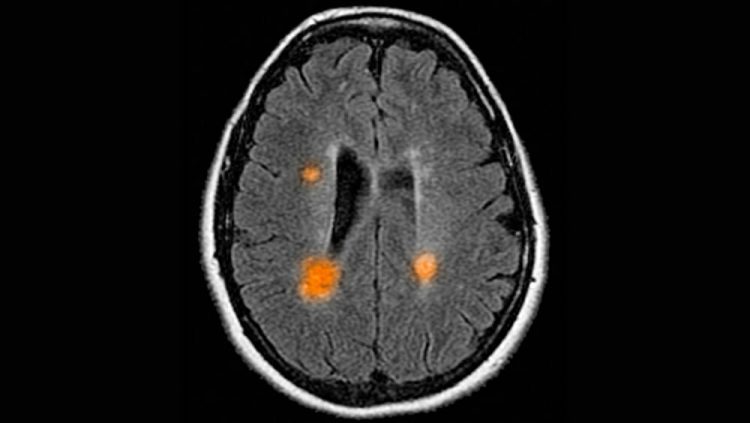 Patients With Newly Diagnosed Multiple Sclerosis More Likely to Have Impaired Cognitive Performance