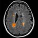 Patients With Newly Diagnosed Multiple Sclerosis More Likely to Have Impaired Cognitive Performance