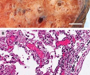 Pulmonary Vascular Endothelialitis, Thrombosis, and Angiogenesis in Covid-19