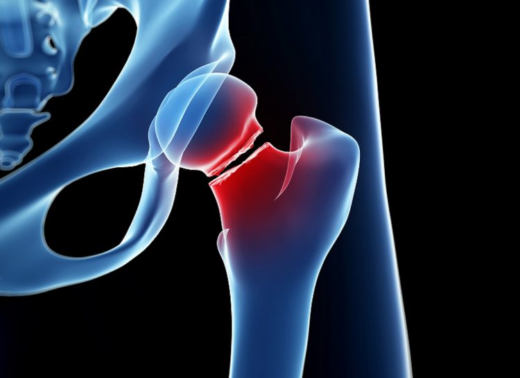 Low Physical Function, Lean Body Mass Predict Accelerated Bone Loss After Hip Fracture