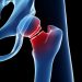 Low Physical Function, Lean Body Mass Predict Accelerated Bone Loss After Hip Fracture