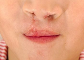 More cleft lip surgeries at age 8 to 10 years tied to later anxiety