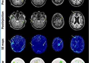 Targeting brain metastases with ultrasmall theranostic nanoparticles, a first-in-human trial from an MRI perspective