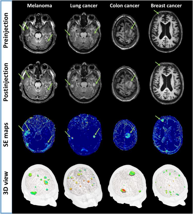 Targeting brain metastases with ultrasmall theranostic nanoparticles, a first-in-human trial from an MRI perspective