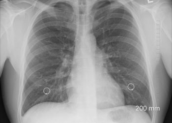 Beyond Pesticides Daily News Blog » Blog Archive Pesticide Use Linked to Increased Risk of Lung Cancer
