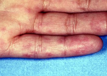 Flare Frequency Associated With Reduced Quality of Life and Family Role Functioning in SLE