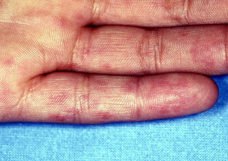 Flare Frequency Associated With Reduced Quality of Life and Family Role Functioning in SLE