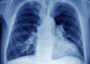 Age-related Differences in Hemodynamics and Functional Status in Pulmonary Arterial Hypertension