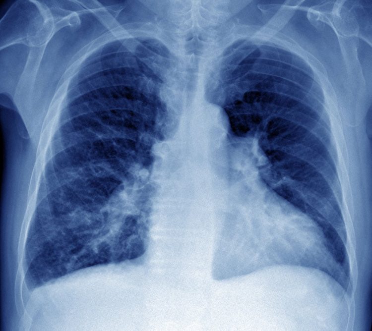 Age-related Differences in Hemodynamics and Functional Status in Pulmonary Arterial Hypertension