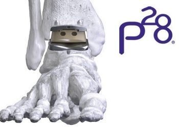 Paragon 28 Completes Series B Financing with Piper Sandler Merchant Banking and MVM Partners – OrthoSpineNews