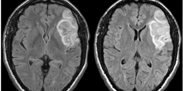 2 Minute Medicine Rewind August 3, 2020