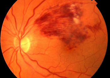 Comprehensive Report on ﻿Retinal Vascular Occlusion Market Set to Witness Huge Growth by 2026 | Regeneron Pharmaceuticals, Inc., Bayer HealthCare Pharmaceuticals LLC., Novartis AG, Pfizer