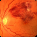 Comprehensive Report on ﻿Retinal Vascular Occlusion Market Set to Witness Huge Growth by 2026 | Regeneron Pharmaceuticals, Inc., Bayer HealthCare Pharmaceuticals LLC., Novartis AG, Pfizer