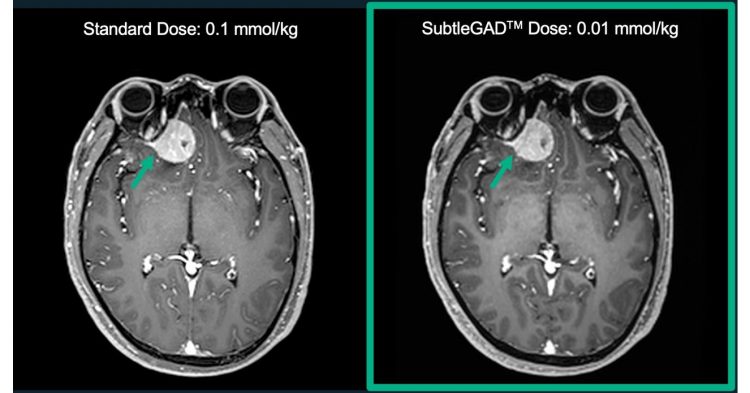 Subtle Medical Awarded Phase II Funding of $1.6 Million SBIR Grant for Safer MRI Exams and Named to CB Insights Digital Health 150