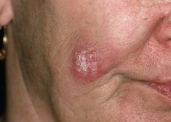 Cosmetic Camouflage for Permanent Facial Lesions in SLE Associated With Improved Quality of Life