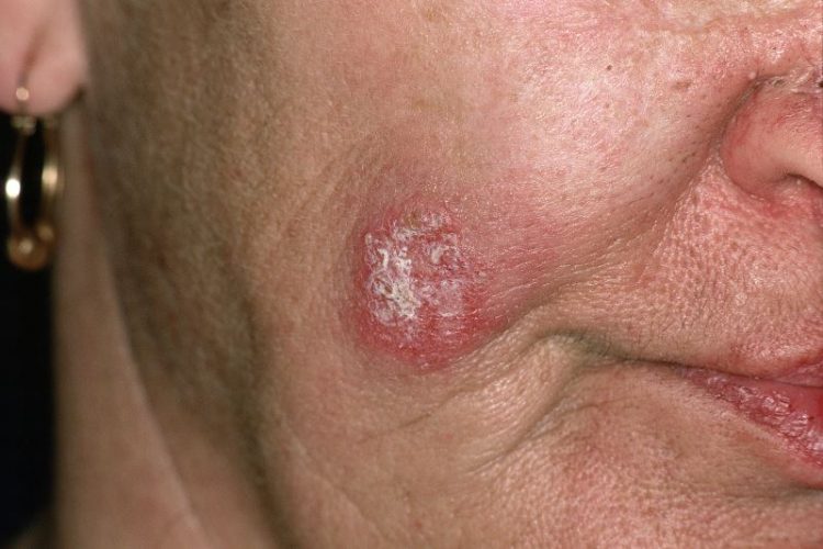 Cosmetic Camouflage for Permanent Facial Lesions in SLE Associated With Improved Quality of Life