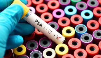 Infertile men have higher PSA compared to fertile ones, says study