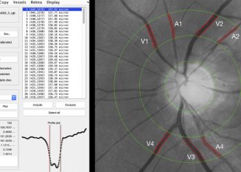 Retinal findings in patients with COVID-19: Results from the SERPICO-19 study