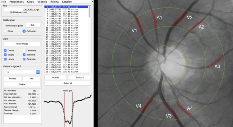 Retinal findings in patients with COVID-19: Results from the SERPICO-19 study