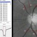 Retinal findings in patients with COVID-19: Results from the SERPICO-19 study