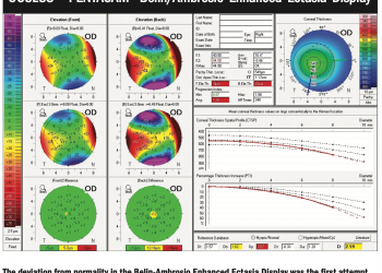 Working out the mystery of ectasia risk with artificial intelligence