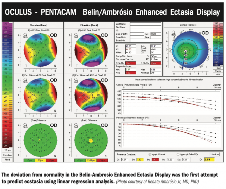 Working out the mystery of ectasia risk with artificial intelligence
