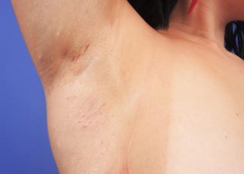 Helping Clinicians Understand Patient Experiences With Hidradenitis Suppurativa