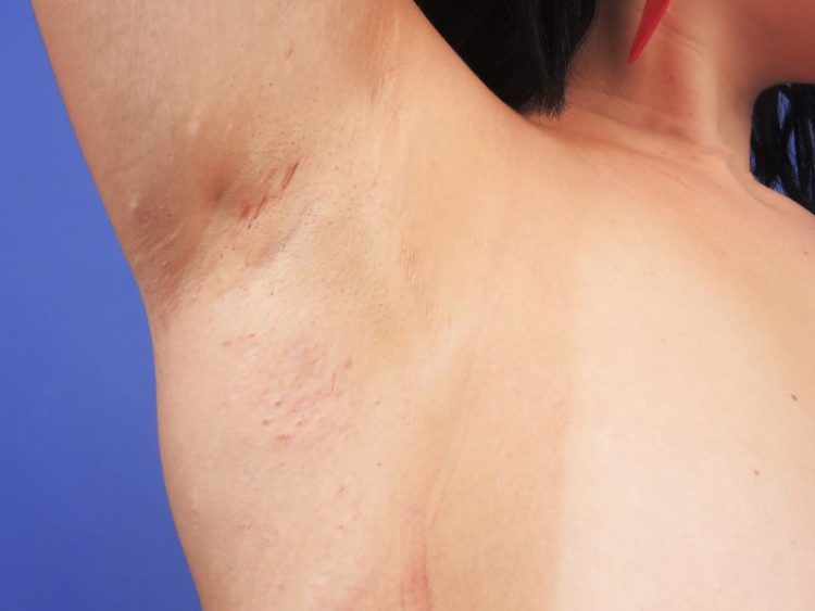 Helping Clinicians Understand Patient Experiences With Hidradenitis Suppurativa