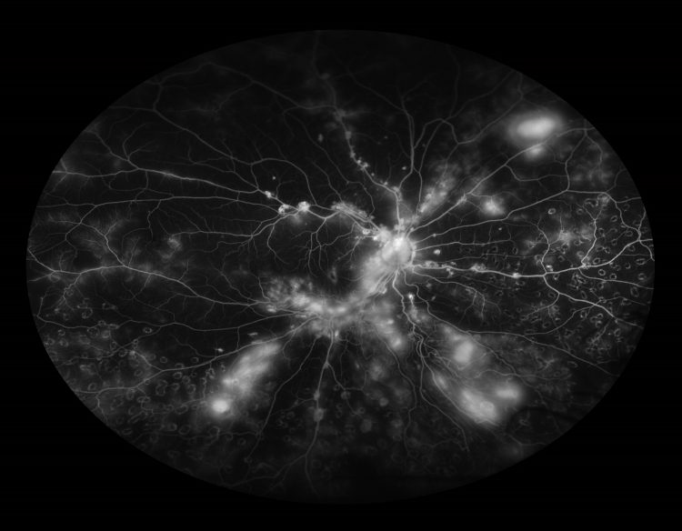 Imaging-Based Uveitis Surveillance Feasible for Patients With Juvenile Idiopathic Arthritis