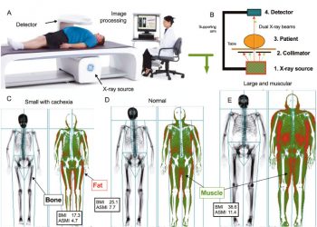 How unmeasured muscle mass affects estimated GFR and diagnostic inaccuracy