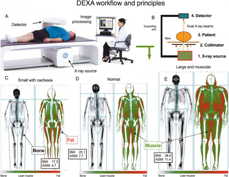 How unmeasured muscle mass affects estimated GFR and diagnostic inaccuracy